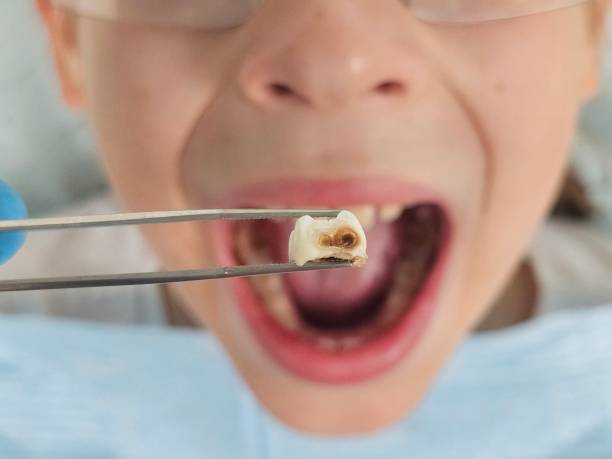 Best Dentist for Tooth Abscess  in Elk Mound, WI